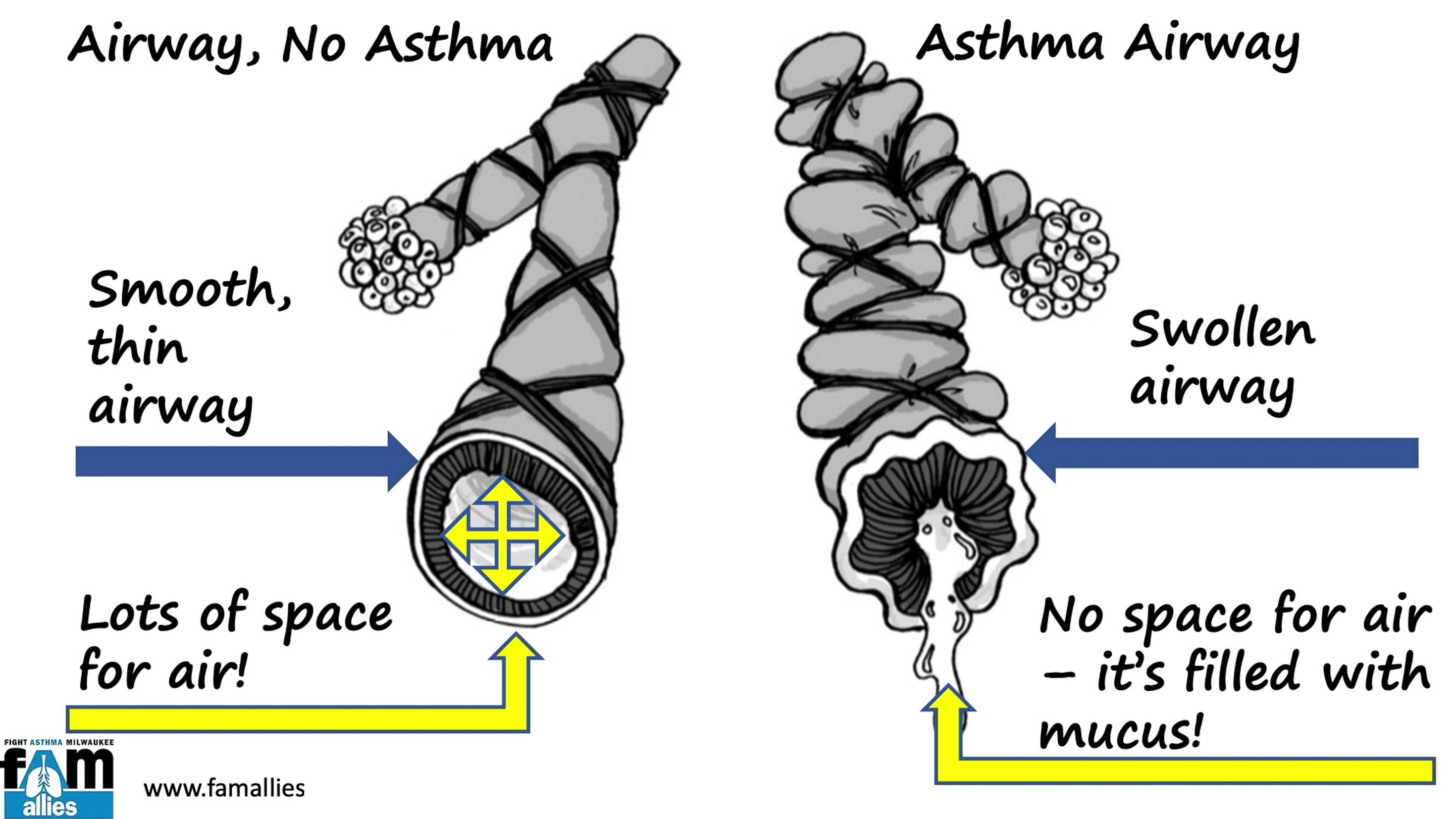 What is Asthma?